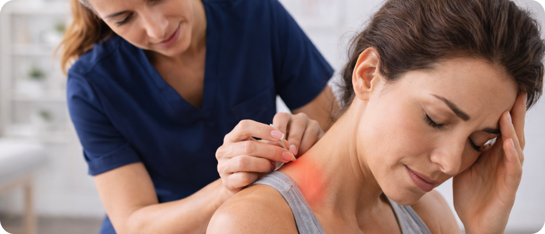 Dry needling therapy for migraine headaches